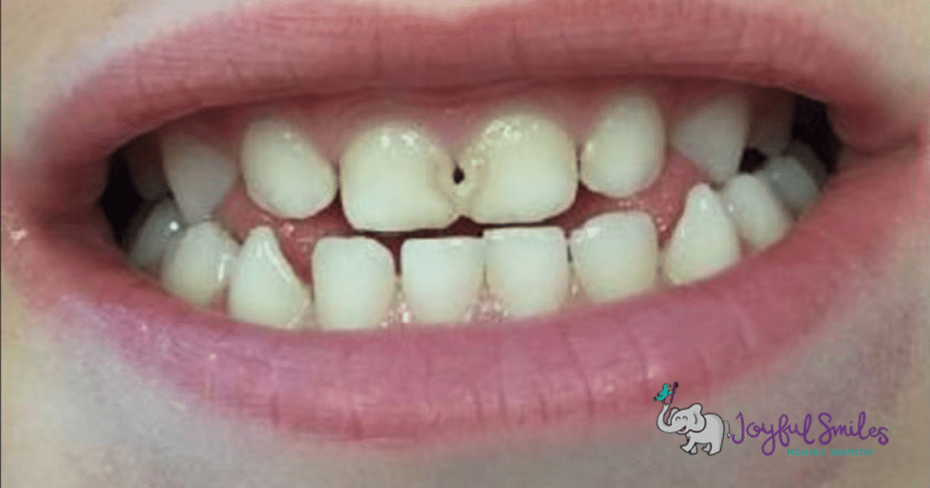 Silver Diamine Fluoride A GameChanger In Pediatric Dentistry